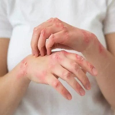Precision Dermatology: Skin Diseases Treatment 1 Precision Dermatology: Skin Diseases Treatment