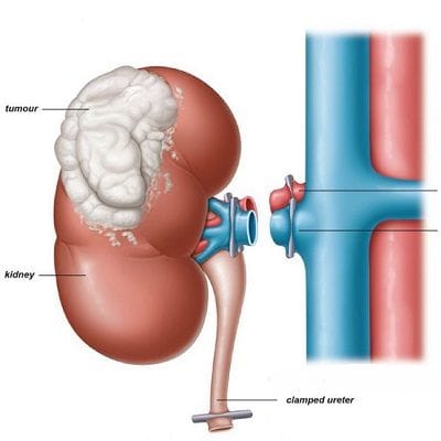 Radical Nephrectomy in Dubai and abu dhabi