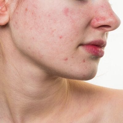 Red Acne Scar Treatment 1 Red Acne Scar Treatment