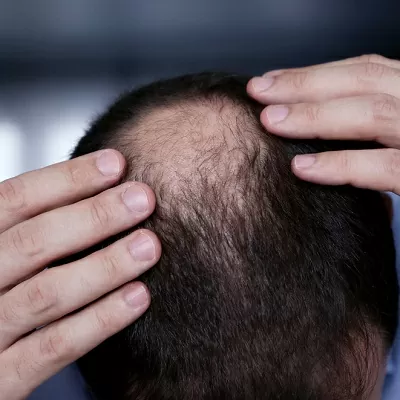 Regenera-Activa-and-Micrograft-Treatment.