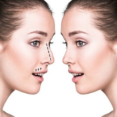 Rhinoplasty Cost for Broken Nose 1 Rhinoplasty Cost for Broken Nose