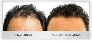 Robotic Hair Transplant 5 Robotic Hair Transplant in Dubai Abu Dhabi