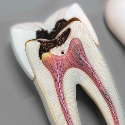 Root Canal Treatment in Dubai for Broken Tooth Cost