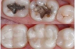 SMART - Dental Amalgam Removal 4 SMART - Dental Amalgam Removal Dubai