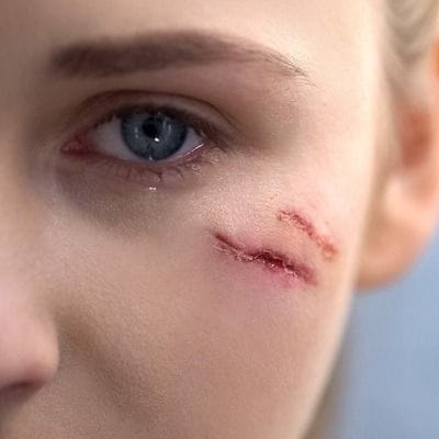 Scar Solutions: Breaking Down Hypertrophic Scars 1 Scar Solutions: Breaking Down Hypertrophic Scars in Dubai