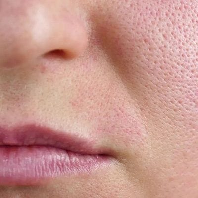Shrink Enlarged Pores with Halo Treatment 1 Shrink Enlarged Pores with HALO Treatment