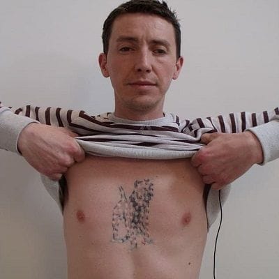 Side Effects of Rejuvi Tattoo Removal