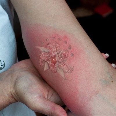 Signs of Infection After Laser Tattoo Removal 1 Signs of Infection After Laser Tattoo Removal