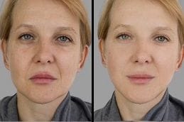Skin Pigmentation Treatment in Dubai