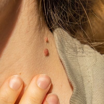 Skin Tag Removal Dubai Silicon Oasis