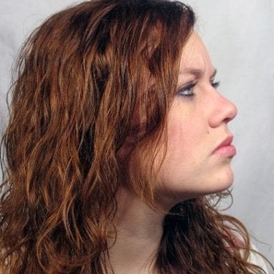 Stem Cell Therapy for Hair Loss Treatment 1 Stem Cell Therapy for Hair Loss Treatment