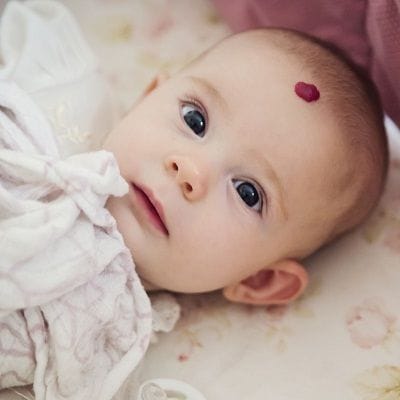 Strawberry Birthmark Removal