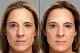 Sunekos Injection Before After