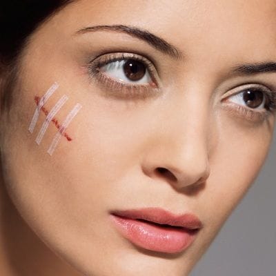 Surgical Scar Revision Cost In Dubai 1 Surgical Scar Revision Cost In Dubai