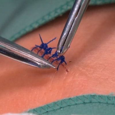 Sutures Removal at Home in Dubai & Abu Dhabi | Removing Stitches at Home