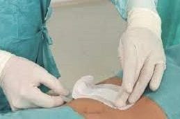 Sutures Removal At Home 4 Sutures Removal at Home in Dubai