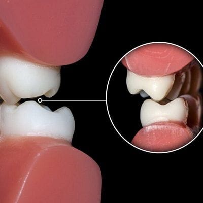 TEETH GRINDING CAUSES SIGNS AND TREATMENT