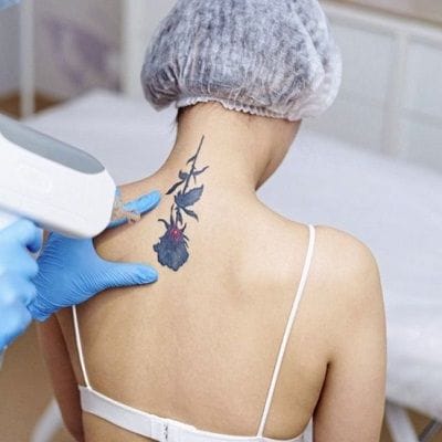When Is The Right Time For Lasers? 1 Tatto Removal