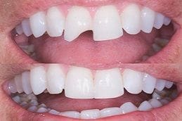 Teeth Fracture Treatment Dubai & Abu Dhabi