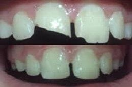 Teeth Fracture Treatment Dubai