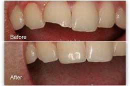Teeth Fracture Treatment in Dubai & Abu Dhabi
