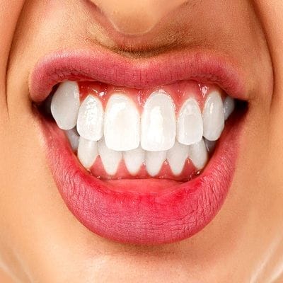 teeth grinding in dubai
