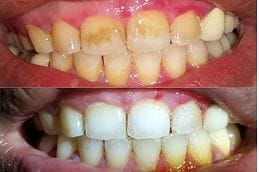 Teeth Polishing & Scaling in Abu Dhabi Teeth Polishing & Scaling in Abu Dhabi