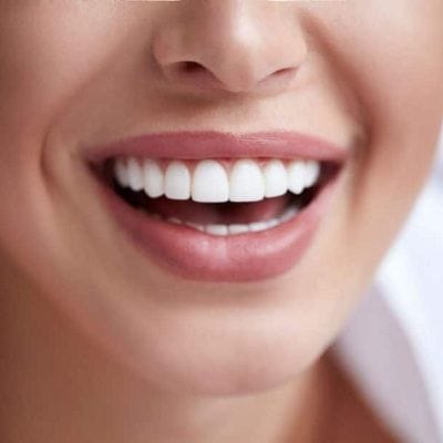 Teeth Whitening Cost