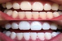 Teeth Whitening Strips 4 Teeth Whitening Strips in Abu Dubai