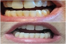 Teeth Whitening Strips 5 Best Teeth Whitening Strips in Abu Dhabi