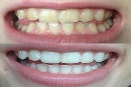 Teeth Whitening Strips 6 Best Teeth Whitening Strips Dubai