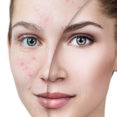 Best Facials for Scars & Hyperpigmentation 1 The Best Facials for Scars & Hyperpigmentation in Dubai
