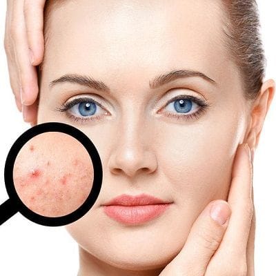 The Various Causes of Acne and How to Fight it Off