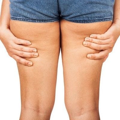 Thigh Lift After Weight Loss in Dubai