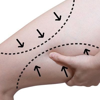 Thigh Lift Cost in Dubai 1 Thigh Lift Surgery Cost in Dubai & Abu Dhabi Dynamic Clinic