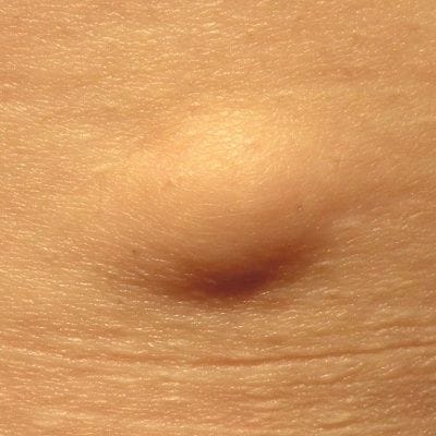 Things you Should Know About Lipoma Treatment in Dubai Dynamic Clinic