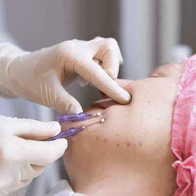 Thread Lift For Jowls