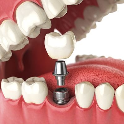 Titanium Dental Implant Cost in Dubai