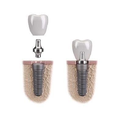 Titanium Dental Implant in Dubai & Abu Dhabi Cost