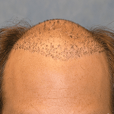 Transform Your Look with Hair Implants in Dubai 1 Transform Your Look With Hair Implants in Dubai