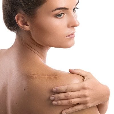 Treatment Option For Keloids