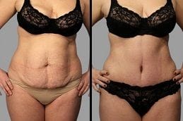 Tummy Tuck | Abdominoplasty 4 Tummy Tuck Before & After