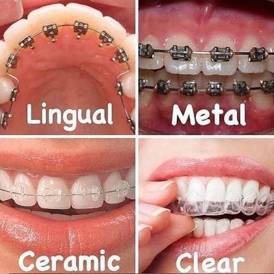 Types Of Braces