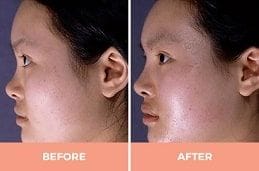 Ultrasonic Rhinoplasty Clinic in Dubai & Abu Dhabi