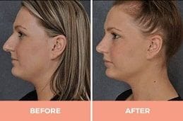 Ultrasonic Rhinoplasty Treatment Dubai & Abu Dhabi