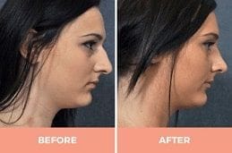 Ultrasonic Rhinoplasty in Dubai & Abu Dhabi
