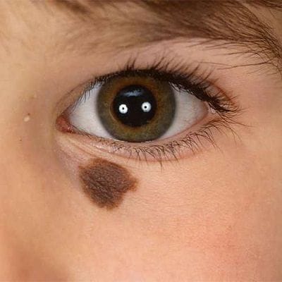 Unlocking Beauty: Birthmark Removal for Clearer Skin