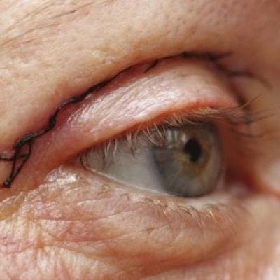Upper Eye Lid Surgery Cost in Dubai & Abu Dhabi