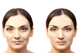 Vampire Facelift Cost Dubai & Abu Dhbai