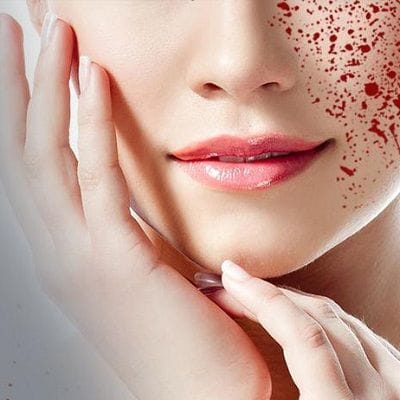 Vampire Facial: What Is It And Why Is It So Popular?